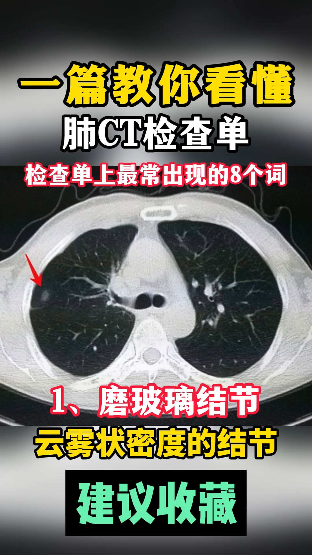 一篇教你看懂CT报告