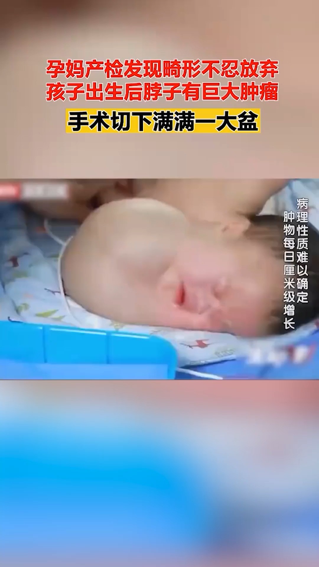 孕妈产检发现畸形不忍放弃,孩子出生后脖子有巨大肿瘤,手术切下满满一大盆