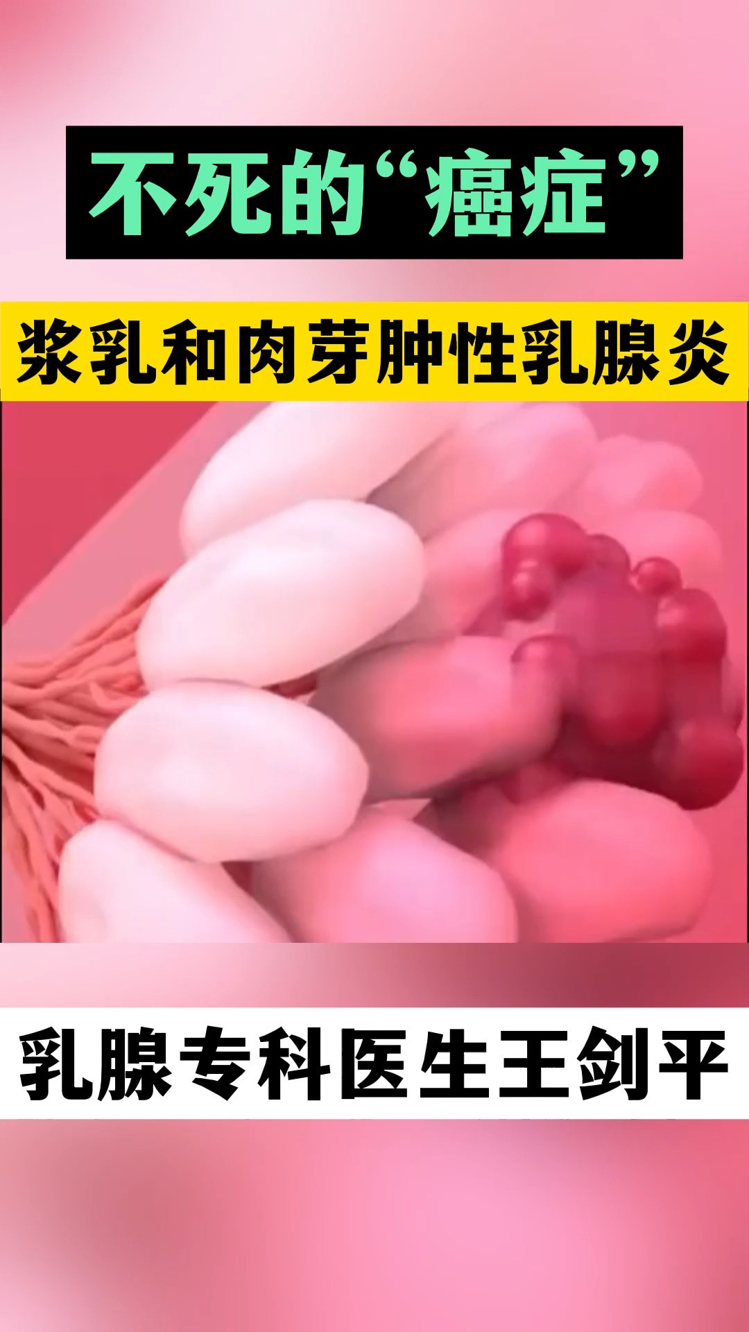 不死的“癌症”,浆乳和肉芽肿性乳腺炎#乳腺炎#肉芽肿性乳腺炎#乳腺健康 