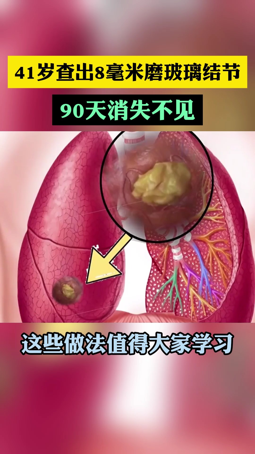 41岁查出8毫米磨玻璃结节,90天消失不见,这些做法值得大家学习