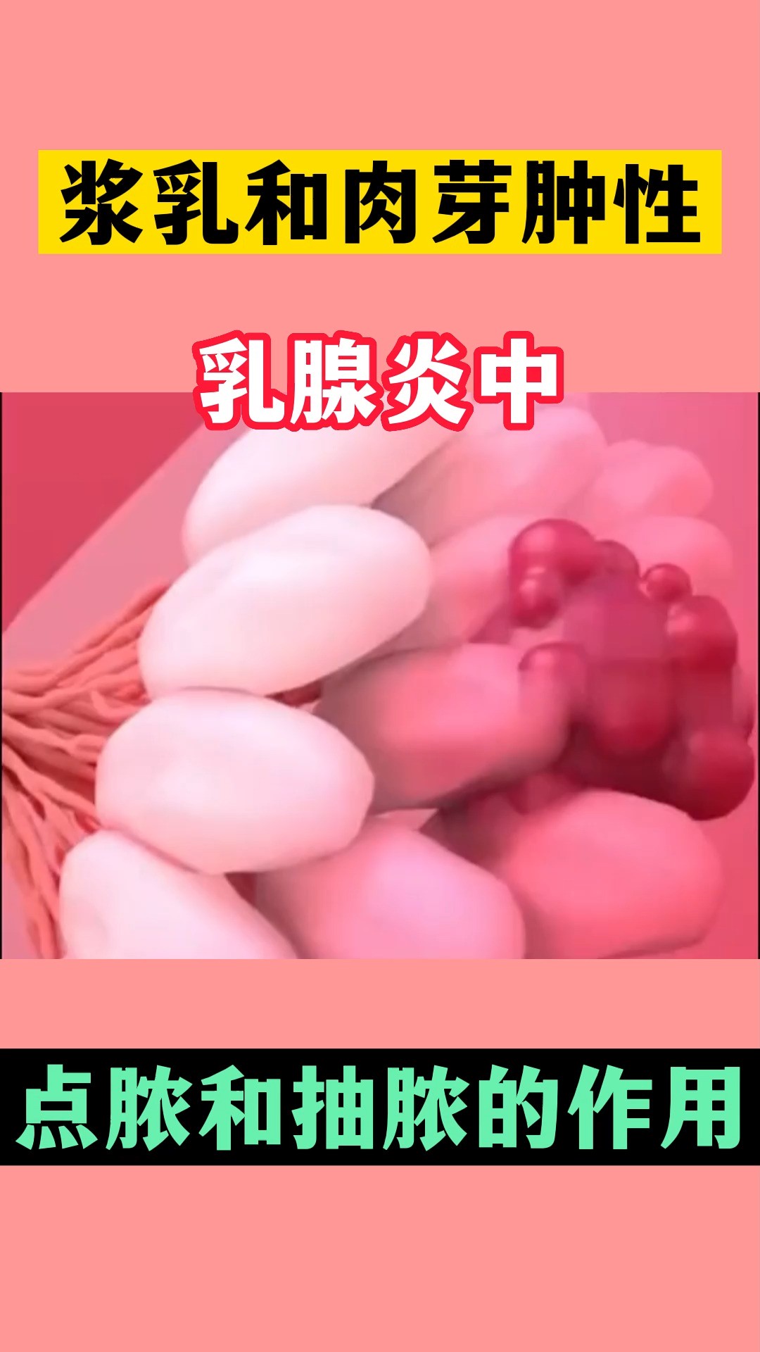 浆乳和肉芽肿性乳腺炎中点脓和抽脓的作用#乳腺健康#乳腺炎#乳腺疾病#急性乳腺炎