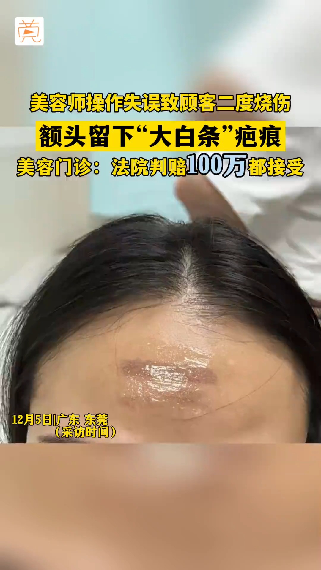 女子被美容师二度烧伤,额头留下“大白条”疤痕,索赔20万元.涉事的东莞市舒尔美医疗美容门诊部称愿意承担全部医疗费,法院判赔100万元也接受#医...