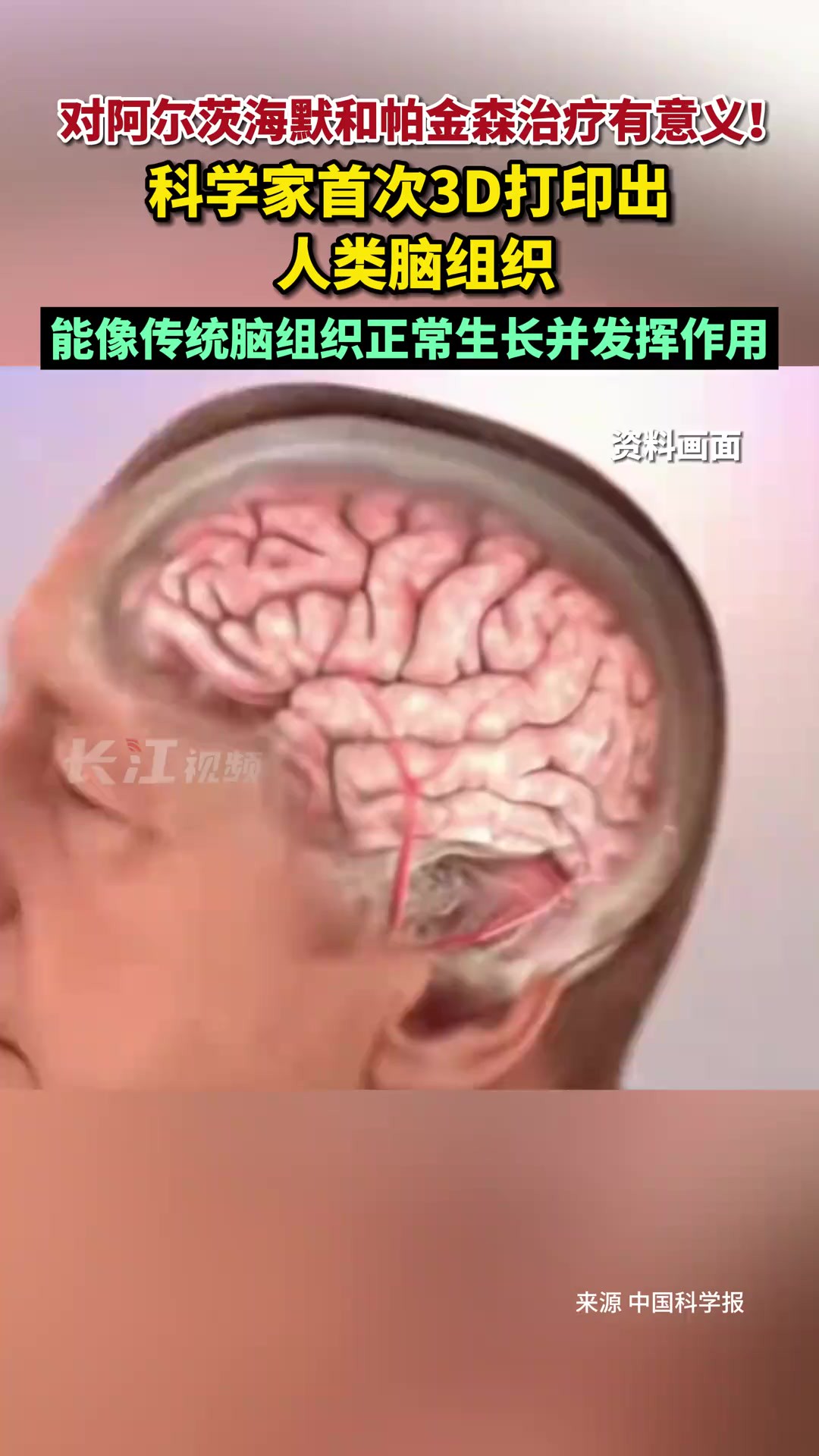 对阿尔茨海默和帕金森治疗有意义!科学家首次3D打印出人类脑组织,能像传统脑组织正常生长并发挥作用.