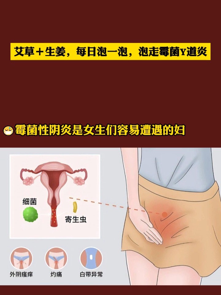 艾草+生姜,每日泡一泡,泡走霉菌性阴道炎