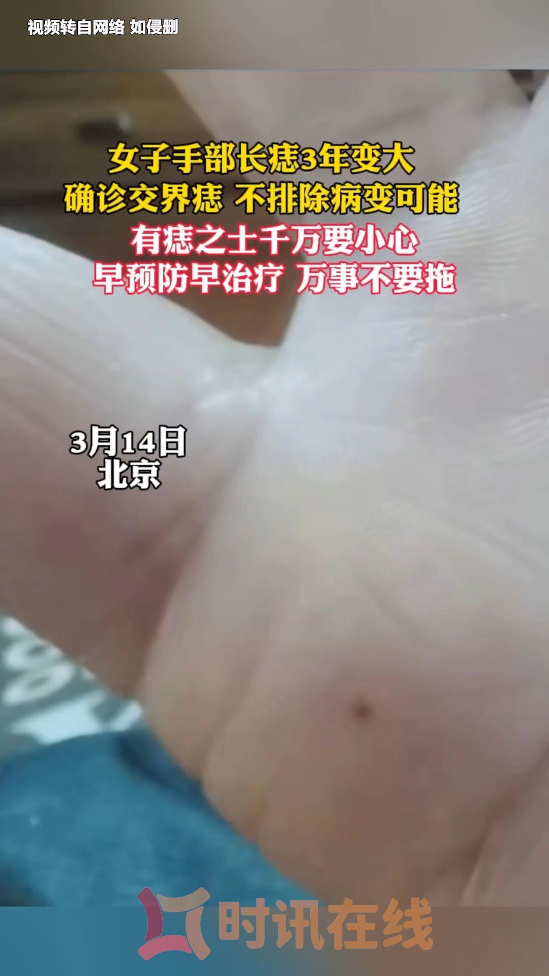 女子手部长痣三年变大确诊交界痣 不排除病变可能