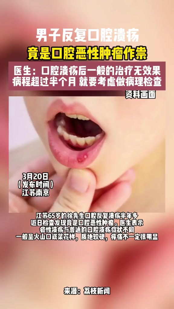 男子口腔反复溃疡竟是恶性肿瘤 编辑胡采棣