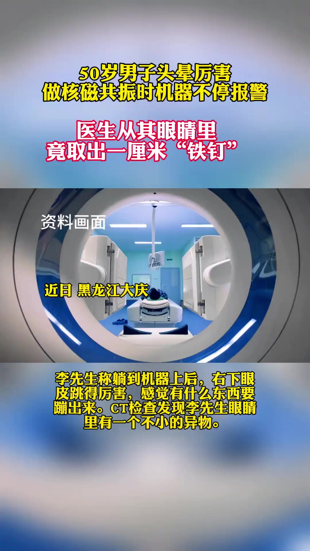 男子做核磁共振时机器不停报警,眼睛里取出“铁钉”.(大庆晚报)