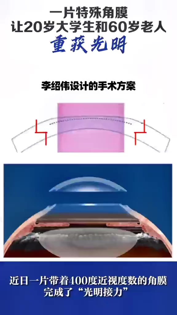 近日,一片带着400度近视度数的角膜完成了“光明接力”,通过这片角膜的移植,分别挽救了一位患圆锥角膜的20岁大学生和一位角膜病变的60岁大叔
