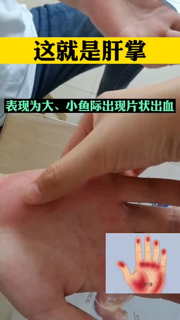 肝掌的典型表现,您都知道吗?