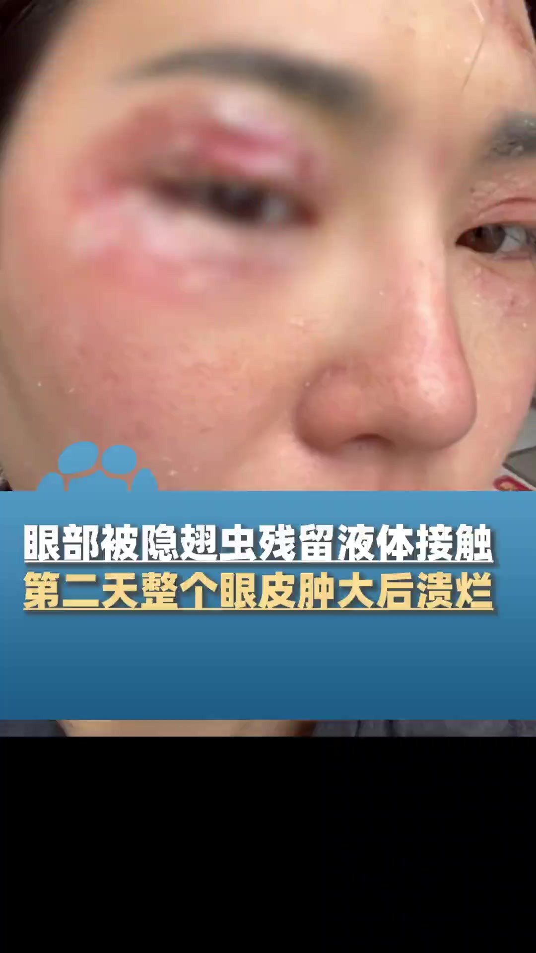 5月10日,湖南娄底,女子眼部被隐翅虫残留液体接触,第二天整个眼皮肿大后溃烂,“有刺痛灼烧感,看东西模糊”