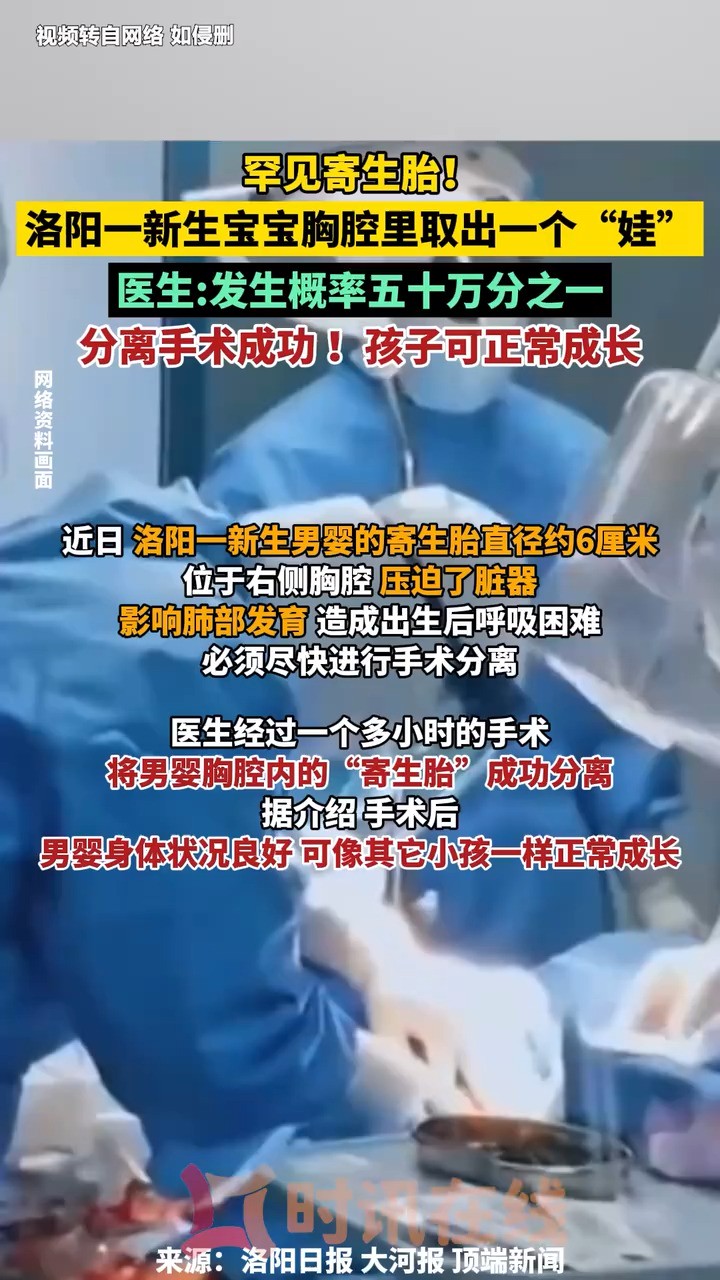 河南医生成功分离罕见胎中胎,发生概率五十万分之一