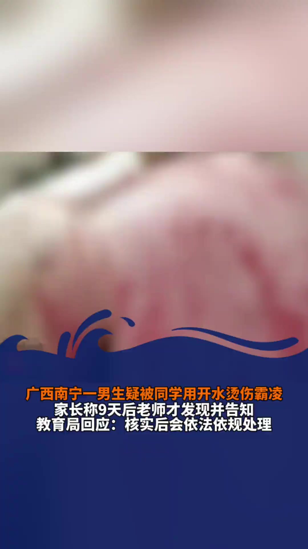 广西南宁一男生疑被同学用11盆开水烫伤霸凌,家长称9天后老师才发现并告知,教育局回应:核实后会依法依规处理