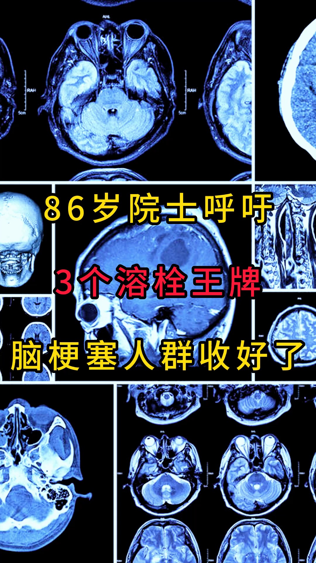 86岁院士呼吁,3个溶栓王牌,脑梗塞人群收好了