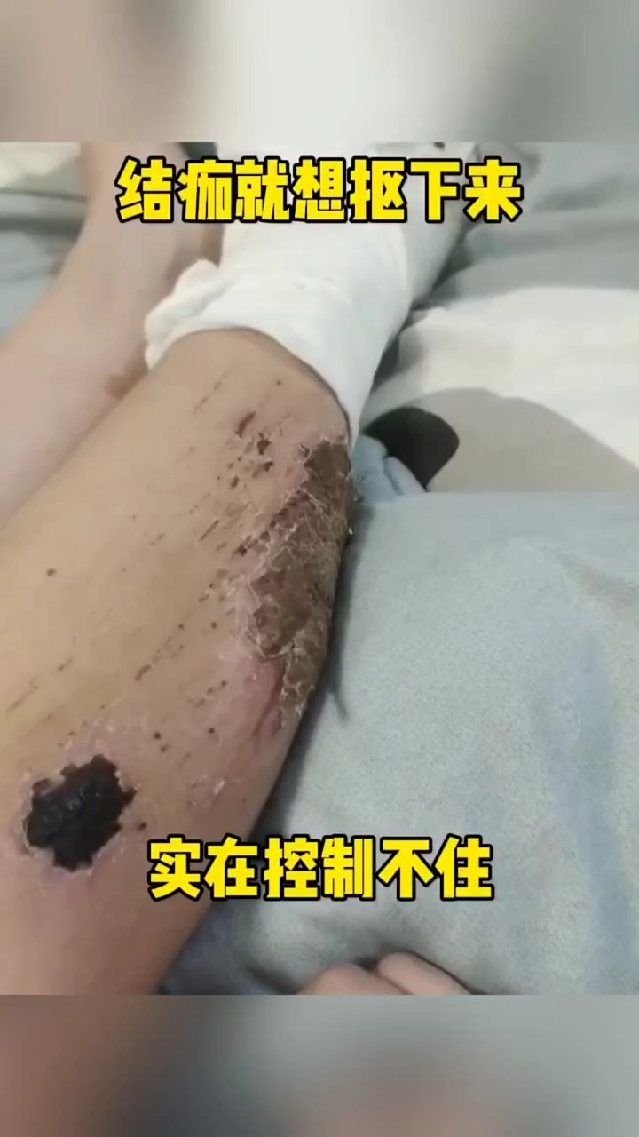 结痂就想抠下来 